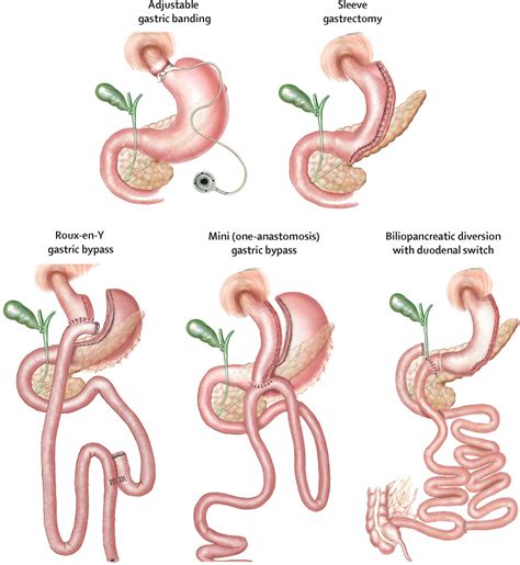 health gastric bypass revision complications